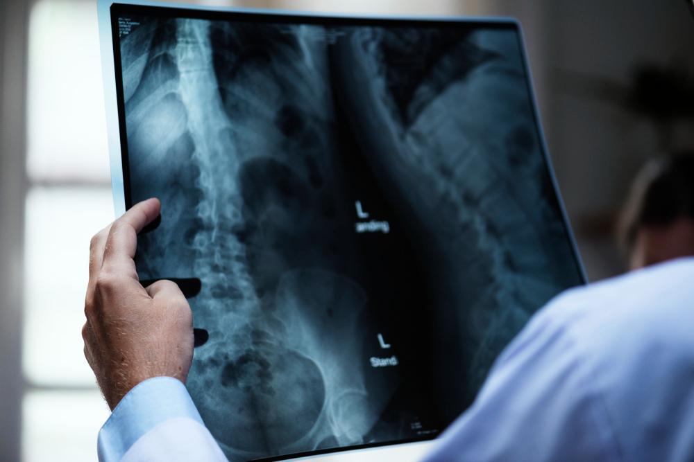 scoliosis treatment  Chapel Hill, NC 